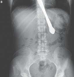 Рентгеновский снимок женщины с ножом внутри