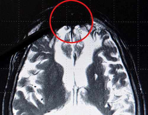 КТ головного мозга и темное пятно