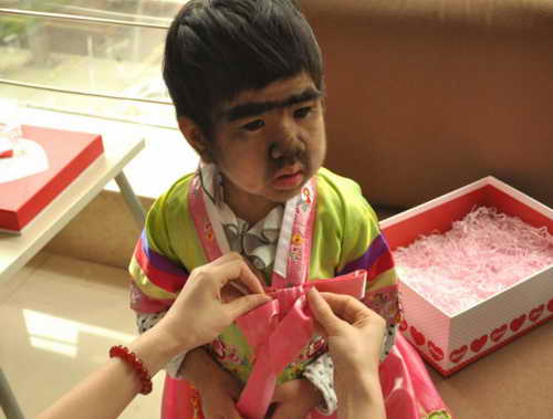 Цзин Цзин, 4 года из Китая с гипертрихозом